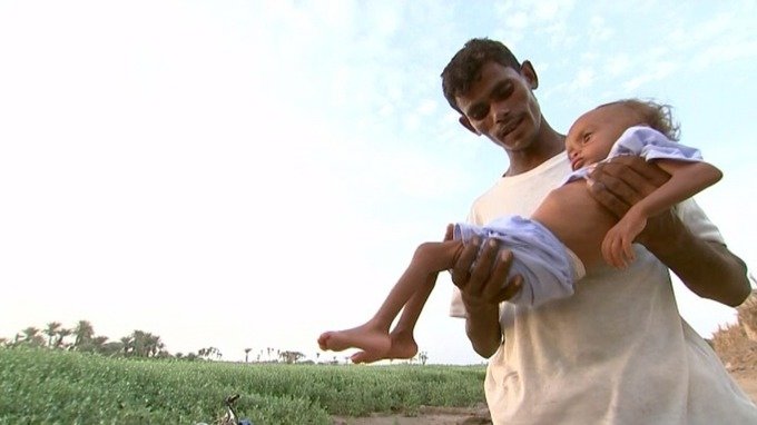 Click to enlarge Yemen's starving children