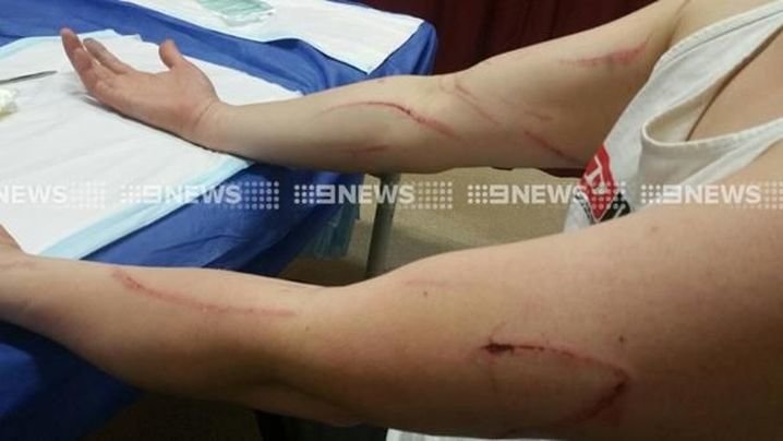 Click to enlarge Mr Lewis suffered severe scratch marks from the attack.