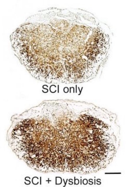 Click to enlarge spinal cord injuries gut dsybiosis