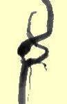carotid bifurcation