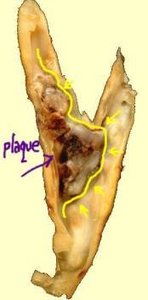 plaque carotid