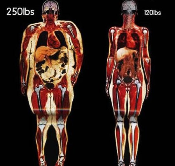obesity MRI