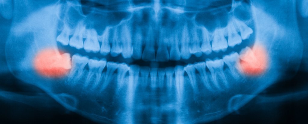 wisdom teeth x-ray