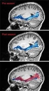 Football children brain scan