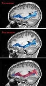 Click to enlarge Football children brain scan