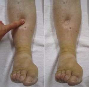 Click to enlarge edema