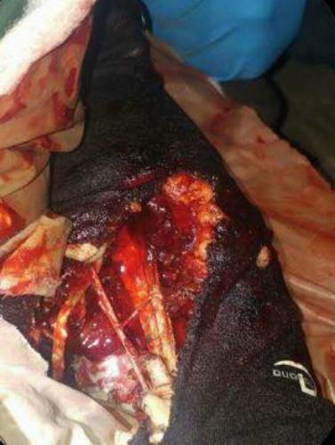 Click to enlarge DAPL Injury