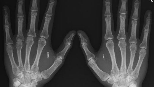 implants x-ray