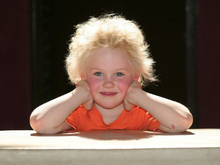 hair genetic condition uncombable
