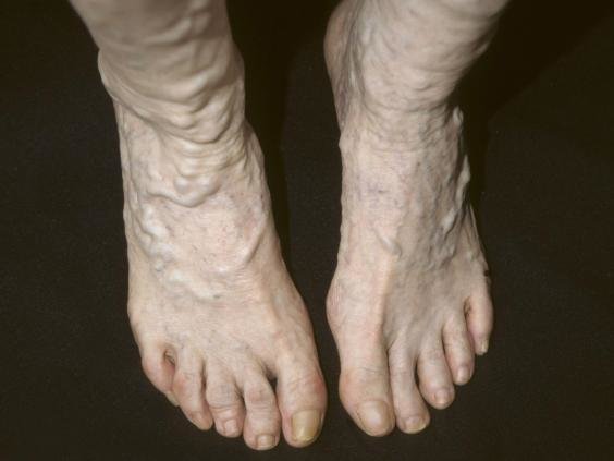 Click to enlarge varicose veins