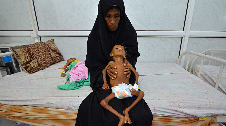 Click to enlarge starvation malnutrition yemen