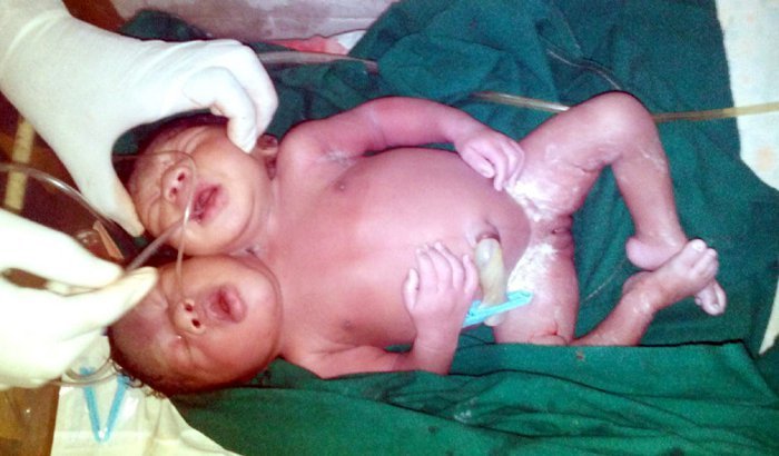Two-Headed Baby 