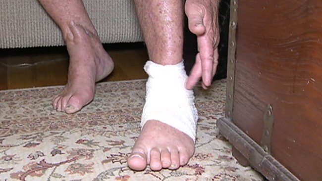 Click to enlarge Tim Roberts' bandaged foot - the wound bled profusely after the bites.
