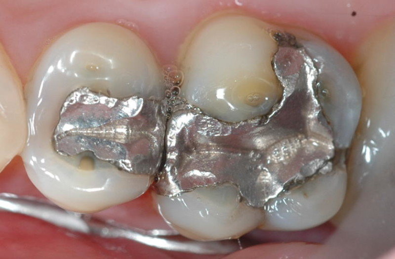 Mercury amalgams
