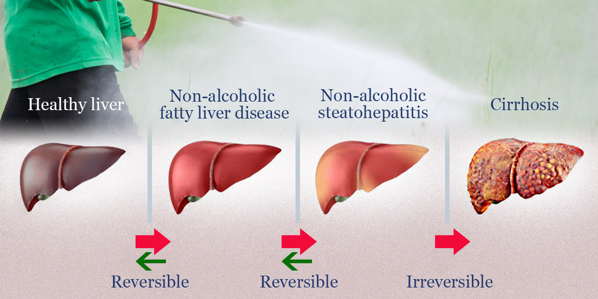 gmo fatty liver