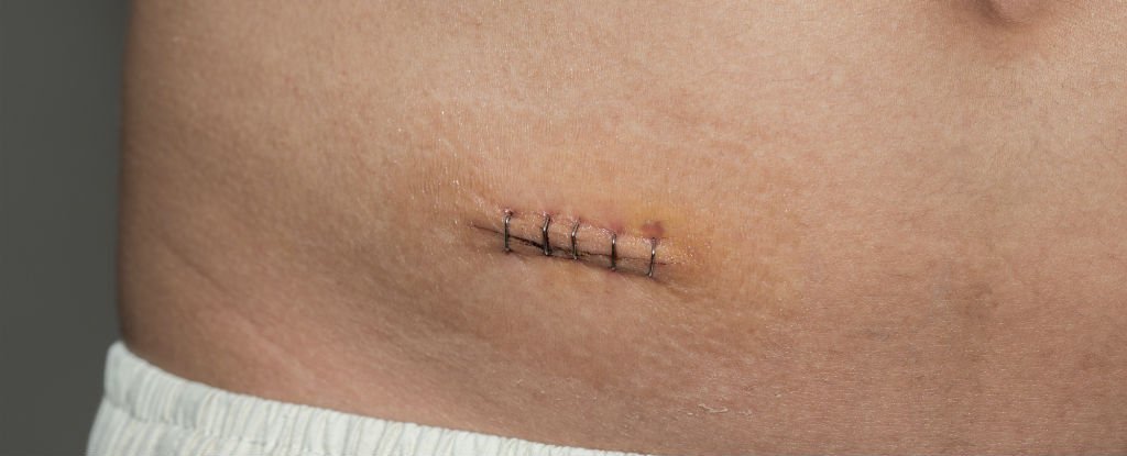 appendix scar