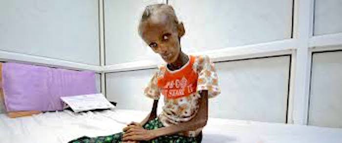 starving Yemeni