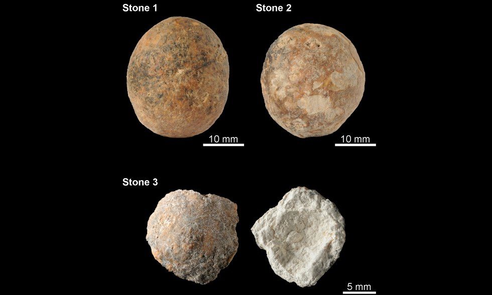 12,000-year-old prostate stones