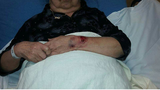 Choua Xiong dog bite