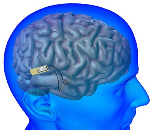 Brain Implant