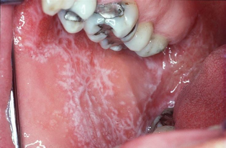 oral lichen planus