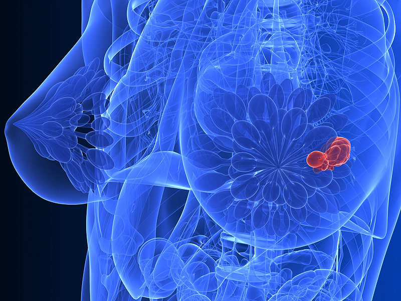 Click to enlarge breast cancer