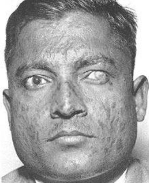 Click to enlarge Small Pox