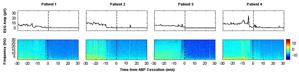  brain scans of the four terminal patients below, showing the moment of clinical death
