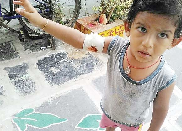 A boy showing bite marks on his right hand at Pedakurapadu in Guntur
