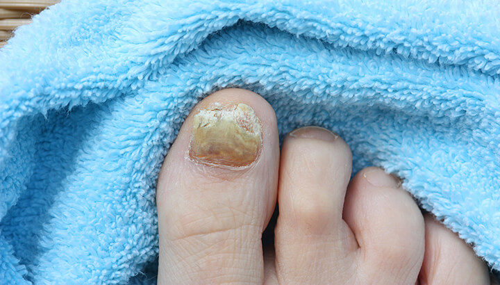 Click to enlarge toenail