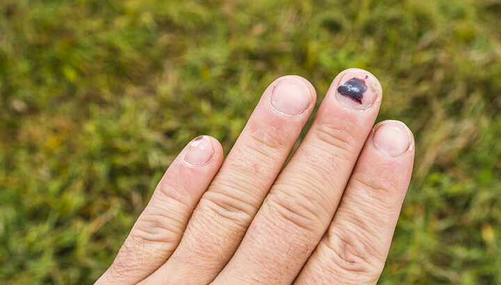Click to enlarge black fingernail