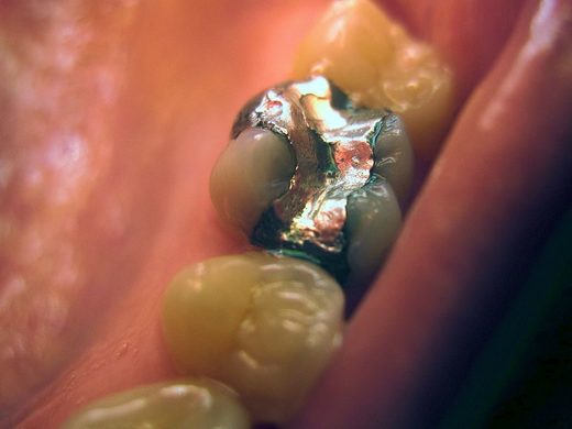 Click to enlarge dental amslgsms