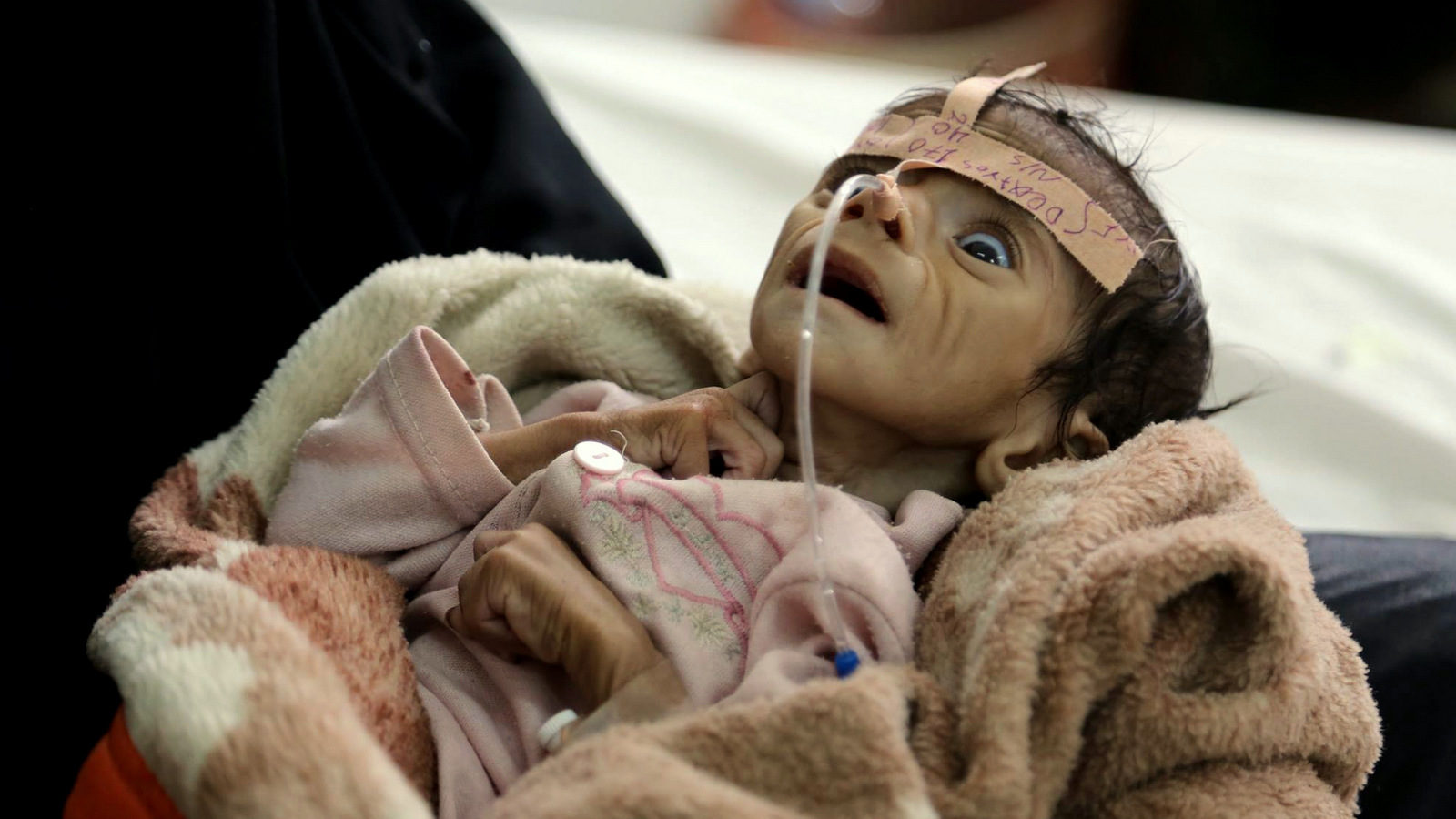 Yemen infant malnutrition starvation
