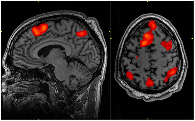 Brain FMRI scan working memory