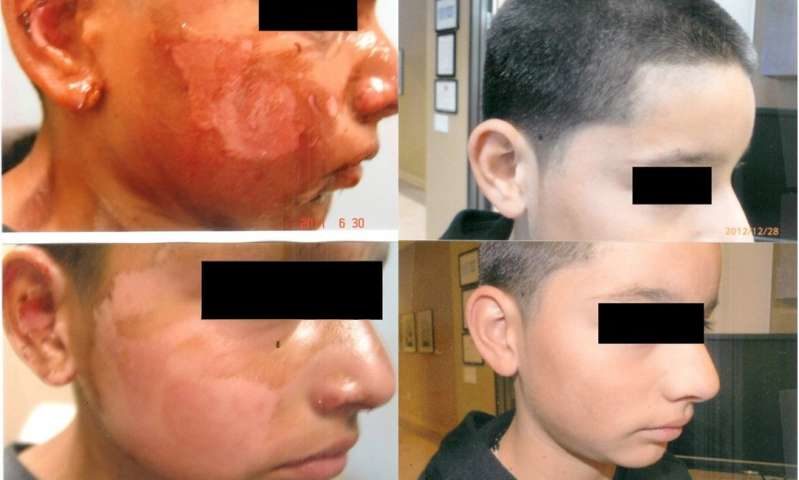 Click to enlarge burned face
