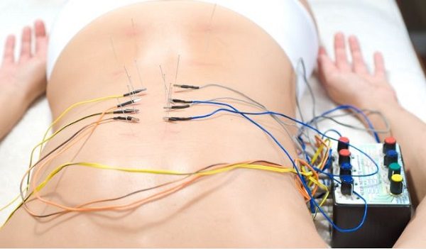 electroacupuncture