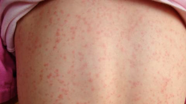 scarlet fever