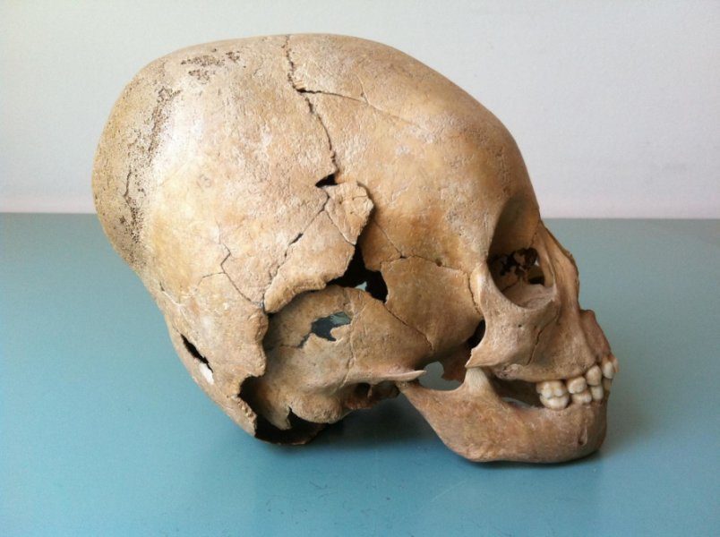 Hun skull