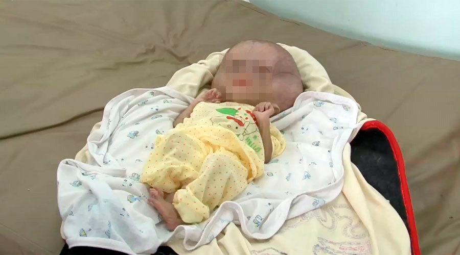 deformed yemen baby