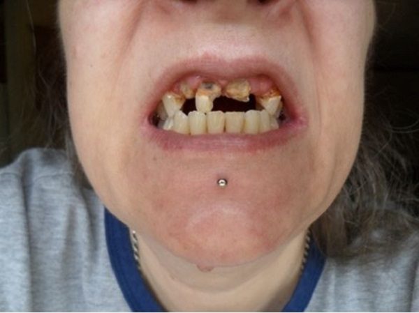 cipro tooth loss