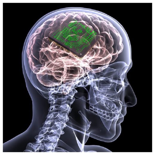 Brain Implant