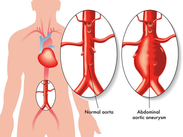 abdominal aneurysm 