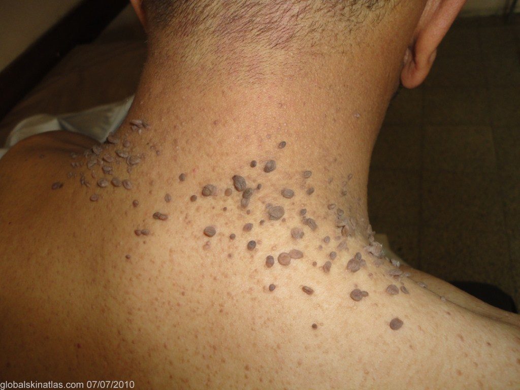 skin tags