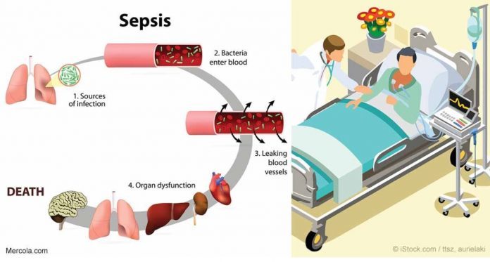 Click to enlarge sepsis