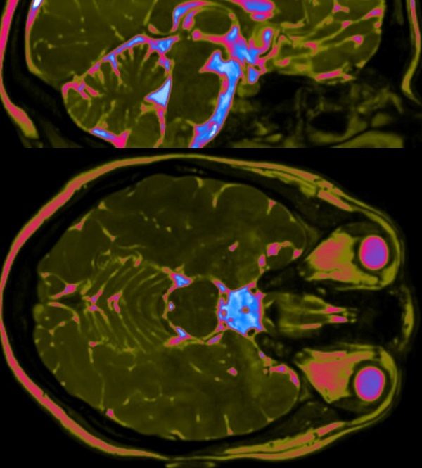 Click to enlarge brain image