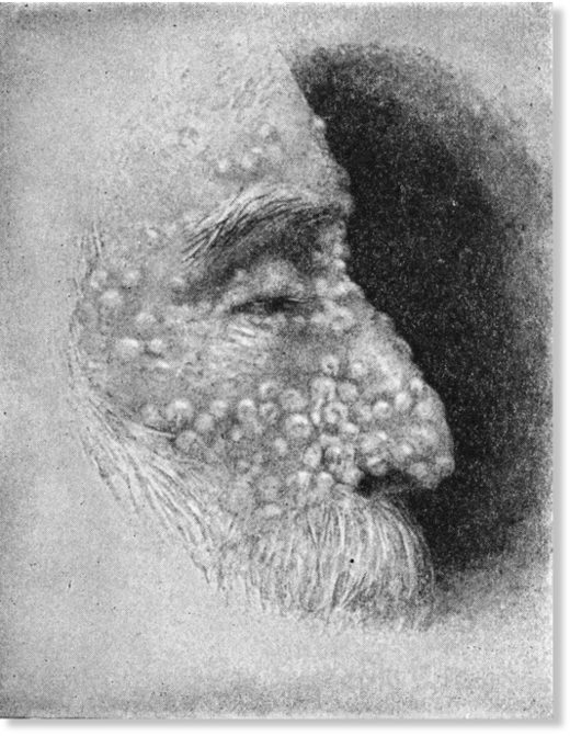 Click to enlarge boil plague