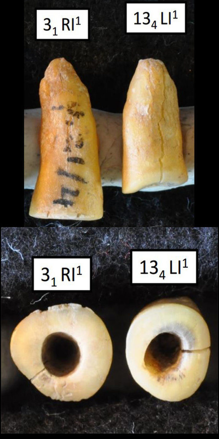 Click to enlarge Tooth Filling