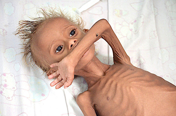 Click to enlarge starving Yemeni child