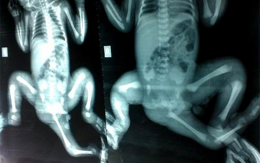 parasitic twin xray