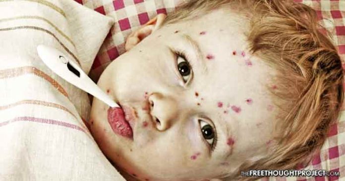 child with chicken pox